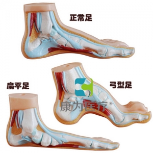 “康為醫(yī)療”正常足、扁平足、弓型足模型