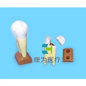 “康為醫(yī)療”上頜兩根齲齒模型(2部分，放大)