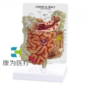 “康為醫(yī)療”醫(yī)患關(guān)系溝通模型-病理大、小腸模型（醫(yī)學指導模型）