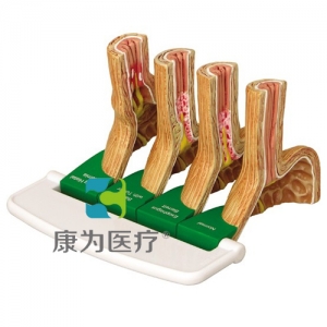 “康為醫(yī)療”醫(yī)患關(guān)系溝通模型-胃食管反流?。℅ERD）模型 （醫(yī)學指導模型）