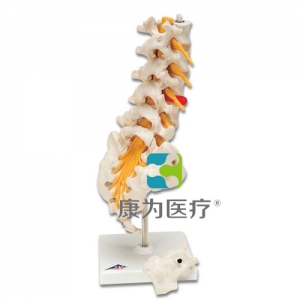 腰脊柱，有脊外側(cè)椎間盤脫出