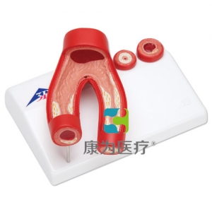 動(dòng)脈硬化模型，帶動(dòng)脈切面，2部分